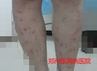 牛皮癣治疗的病例