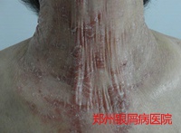 牛皮癣治疗的病例