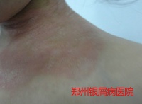 牛皮癣治疗的病例