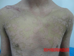 牛皮癣治疗图片