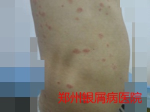牛皮癣治疗图