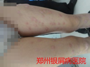 牛皮癣治疗图