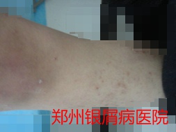 银屑病治疗图片