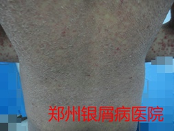 银屑病治疗图片