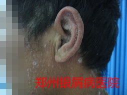银屑病治疗图片