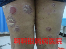 银屑病治疗图片