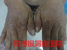 银屑病治疗图片