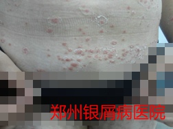 银屑病治疗图片