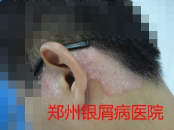 牛皮癣治疗图片