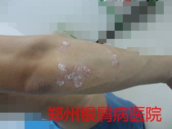 牛皮癣治疗图片