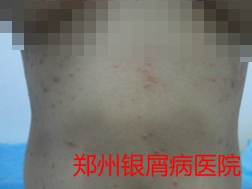 牛皮癣治疗图片