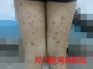 郑州牛皮癣医院牛皮癣治疗图片