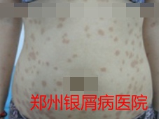 郑州牛皮癣医院牛皮癣治疗图片