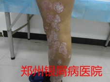 郑州牛皮癣医院牛皮癣治疗图片