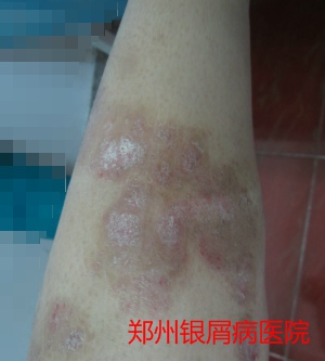 郑州牛皮癣医院治疗牛皮癣图片