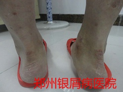 郑州牛皮癣医院治疗牛皮癣图片