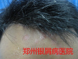郑州牛皮癣医院牛皮癣治疗图片