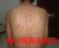 郑州牛皮癣医院牛皮癣治疗图片