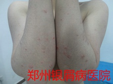 郑州牛皮癣医院牛皮癣治疗图片