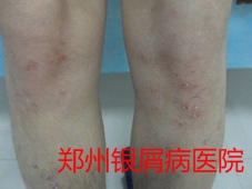 郑州牛皮癣医院治疗牛皮癣图片