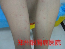 郑州牛皮癣医院牛皮癣治疗图片