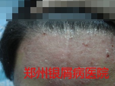 郑州牛皮癣医院牛皮癣治疗图片