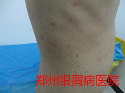 郑州牛皮癣医院牛皮癣治疗图片
