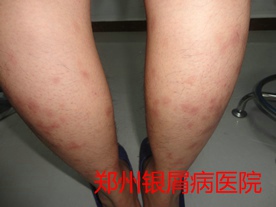 郑州牛皮癣医院治疗牛皮癣图片