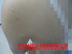 郑州牛皮癣医院治疗牛皮癣图片