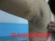 郑州牛皮癣医院治疗牛皮癣图片