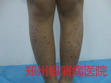 郑州牛皮癣医院治疗牛皮癣图片