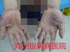 郑州牛皮癣医院治疗牛皮癣图片