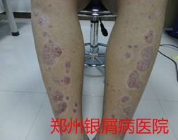 郑州牛皮癣医院治疗牛皮癣图片