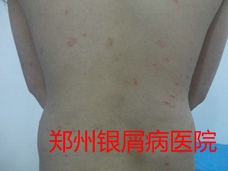 郑州牛皮癣医院治疗牛皮癣图片