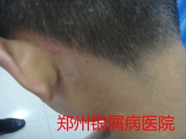 郑州牛皮癣医院治疗牛皮癣图片