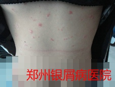 郑州牛皮癣医院治疗牛皮癣图片