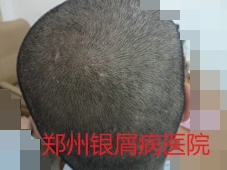 郑州牛皮癣医院牛皮癣治疗图片