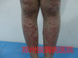 郑州牛皮癣医院牛皮癣治疗图片