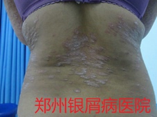 郑州牛皮癣医院牛皮癣治疗图片
