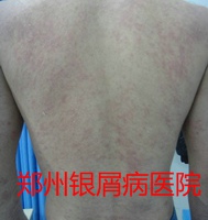 郑州牛皮癣医院治疗牛皮癣图片