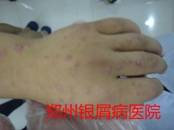 郑州牛皮癣医院治疗牛皮癣图片