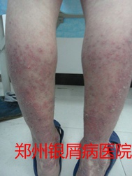 郑州牛皮癣医院治疗牛皮癣图片