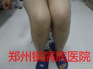 郑州牛皮癣医院治疗牛皮癣图片