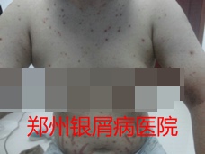 郑州牛皮癣医院治疗牛皮癣图片