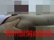 郑州牛皮癣医院治疗牛皮癣图片