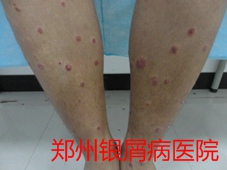 郑州牛皮癣医院治疗牛皮癣图片