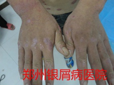 郑州牛皮癣医院治疗牛皮癣图片