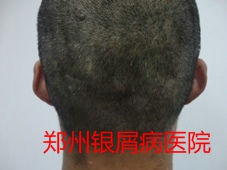 郑州牛皮癣医院治疗牛皮癣图片
