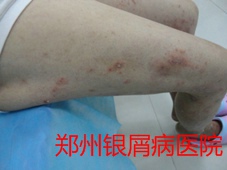 郑州牛皮癣医院治疗牛皮癣图片