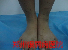 郑州牛皮癣医院治疗牛皮癣图片